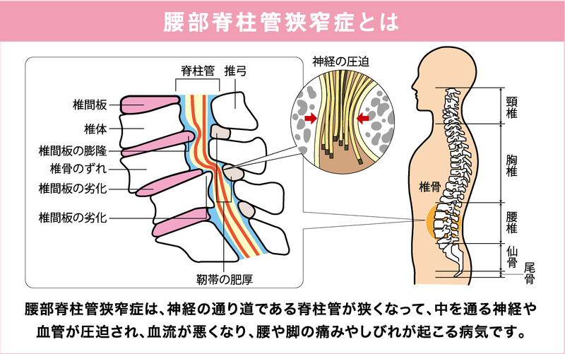 脊柱管狭窄症の解説画像