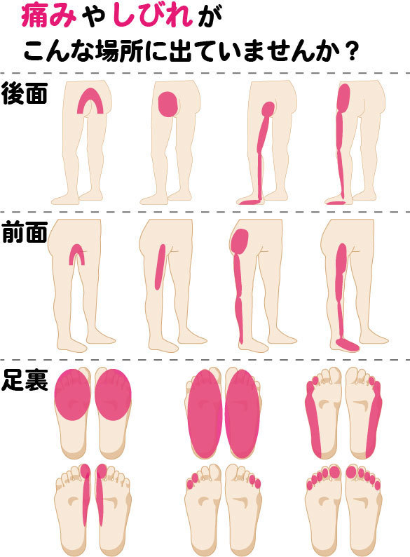 坐骨神経痛で起こる様々な症状の画像