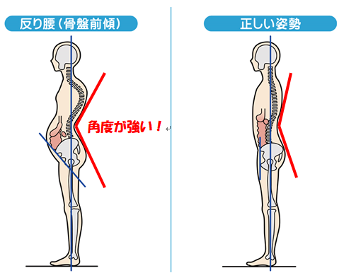 反り腰の写真