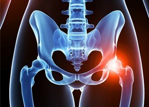 股関節痛の画像