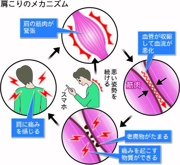 肩こりのメカニズムの画像