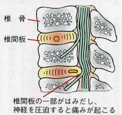 椎間板ヘルニアの解説画像