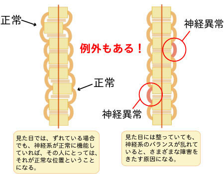 歪みがあっても痛みは無いという解説の画像