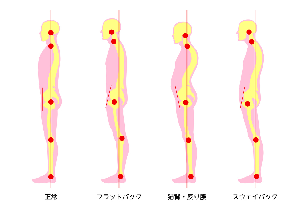 立位時の不良姿勢の画像