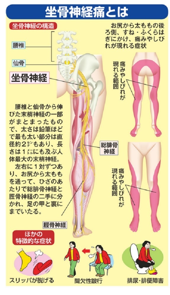 坐骨神経痛の解説画像