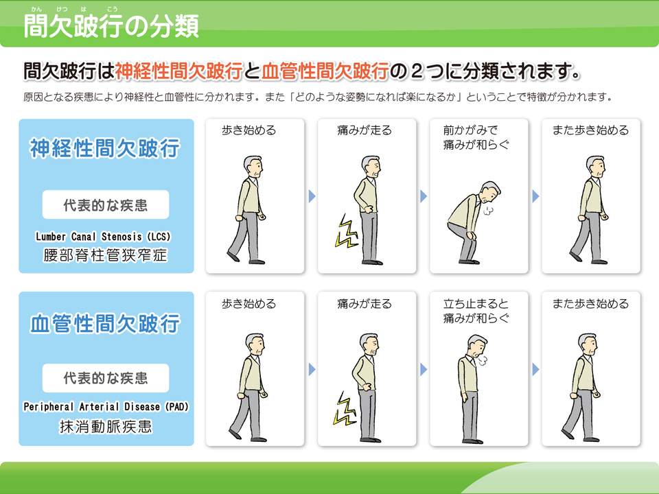 タイプ別の間欠性跛行の解説画像