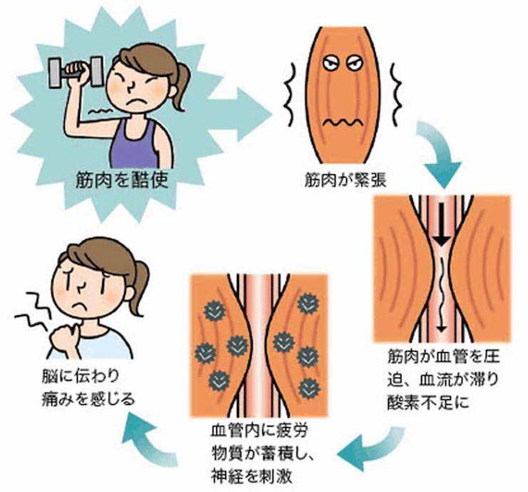 筋疲労から痛みへのメカニズムの解説画像