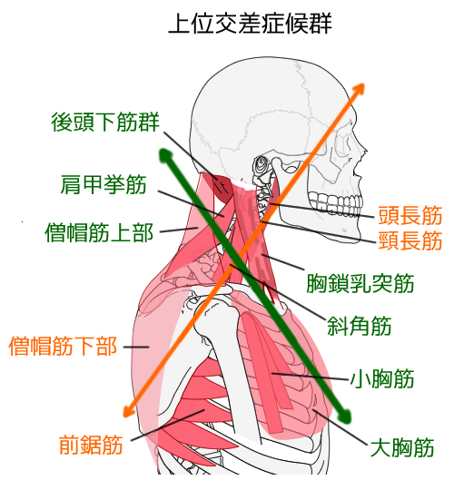 不良姿勢で起こる筋緊張を解説し画像