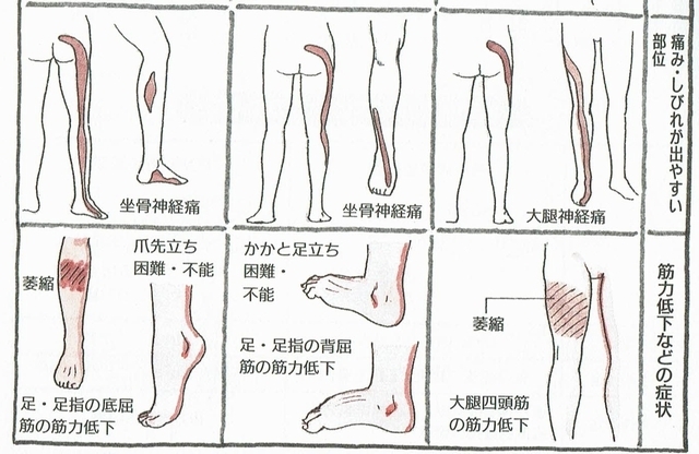 障害された神経による椎間板ヘルニアの症状の画像