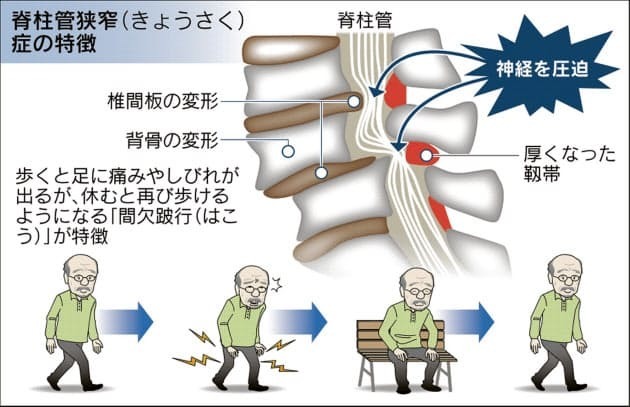 間欠性跛行の説明画像