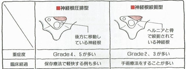 ヘルニアの圧排型と絞扼型の解説画像