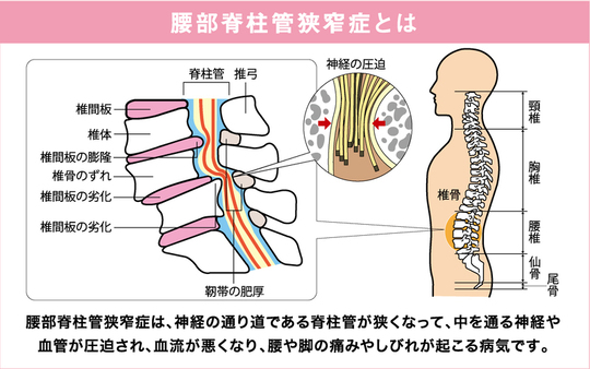 勃起不全の進歩